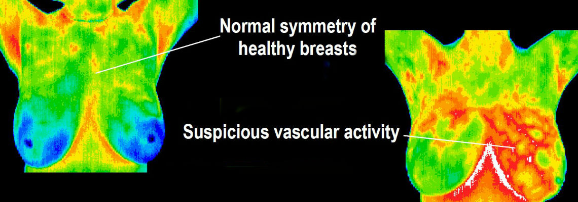 breastsymmetry