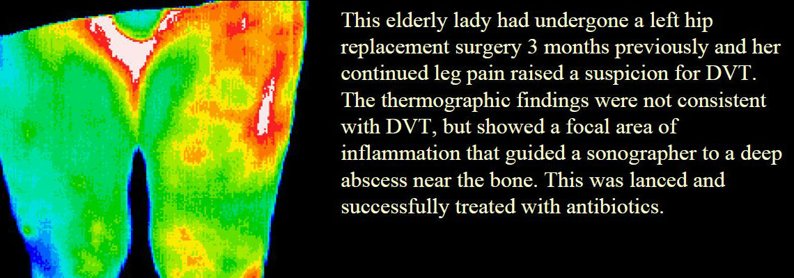 hipreplacement