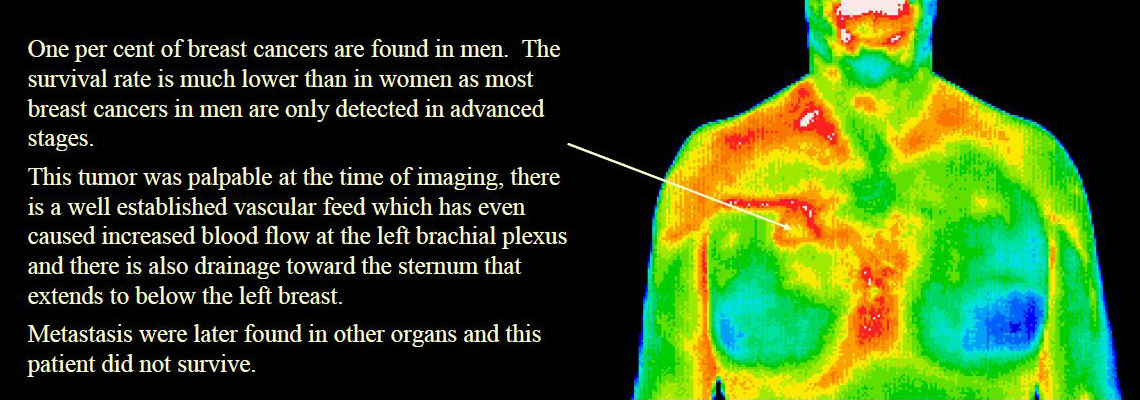 malebreastcancer