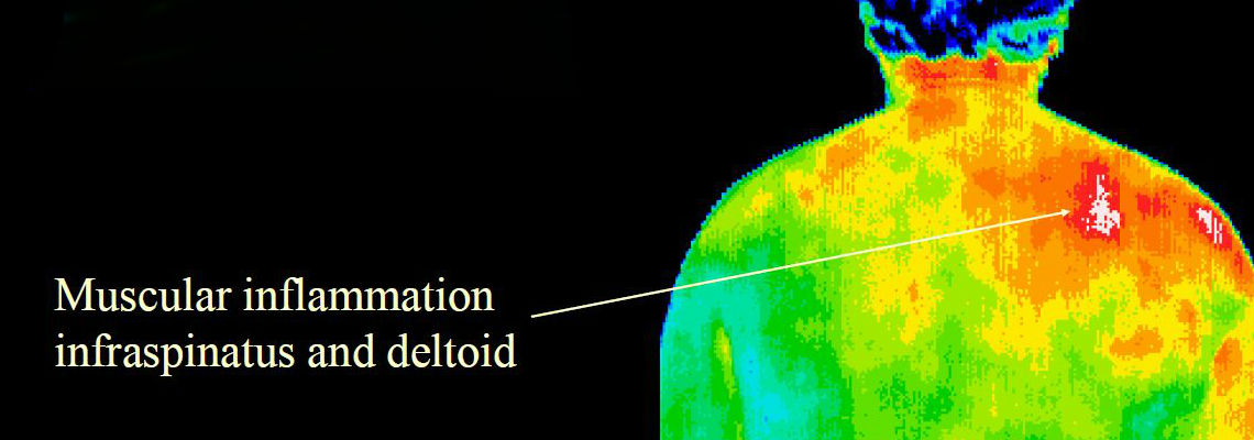 muscularinflammation