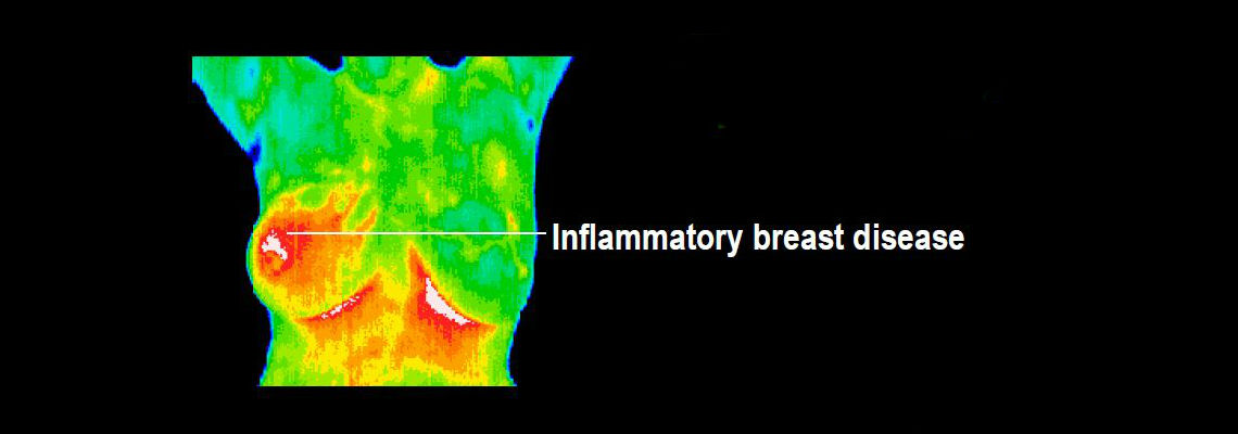 Inflammatory Breast